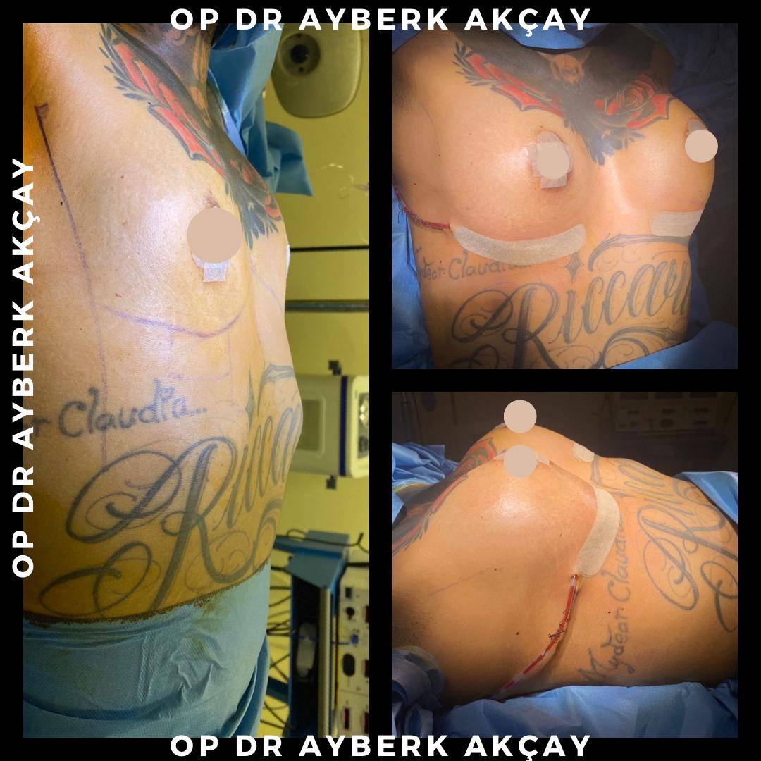 Before and after images of a patient who underwent successful breast augmentation surgery by Dr. Ayberk, showcasing remarkable transformation and improved body contour